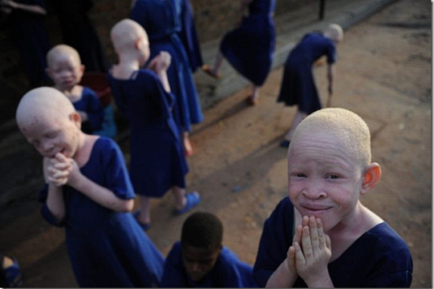 Проблема альбиносов в Африке