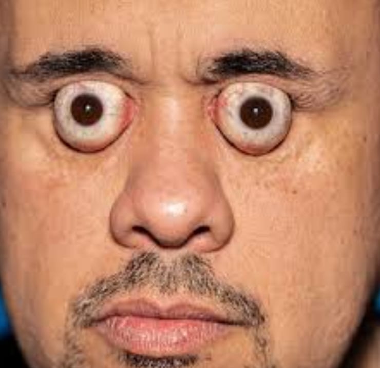 глаза навыкат