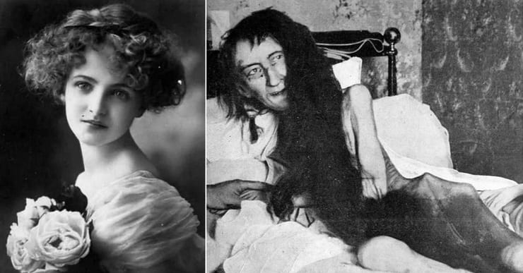 фото бланш монье до и после