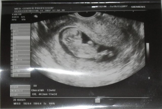 развитие эмбриона около 11 недель