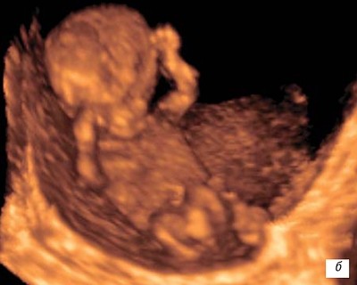 строение плода в конце первого триместра