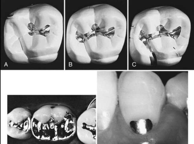 Фото Зубные пломбы