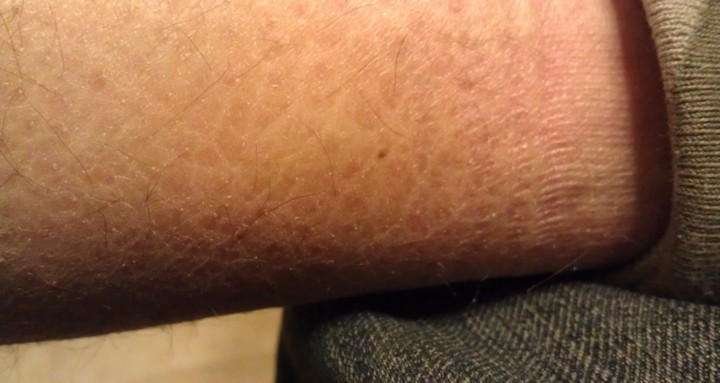 Фото Кожа может превращаться в чешую