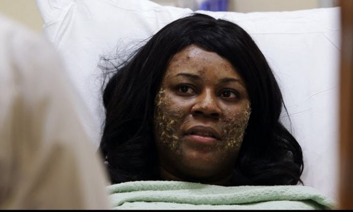 Фото Редкий случай заболевания: ногти вместо волос